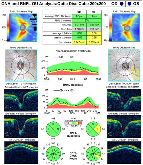 normal optic nerve thickness